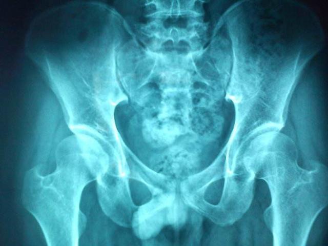 宝宝下肢大腿纹和臀纹不对称是髋关节发育异常吗?改怎么办?