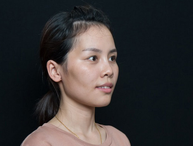 妹子脸部比较凹陷主要问题是太阳穴凹陷脸颊凹陷苹果肌不饱满