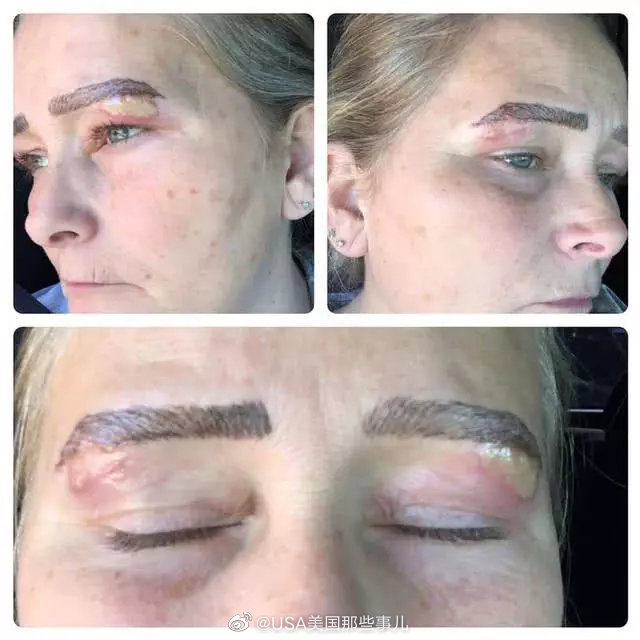 美国密歇根州一名女子花了350美元在当地美容院做了一个半永久纹眉项
