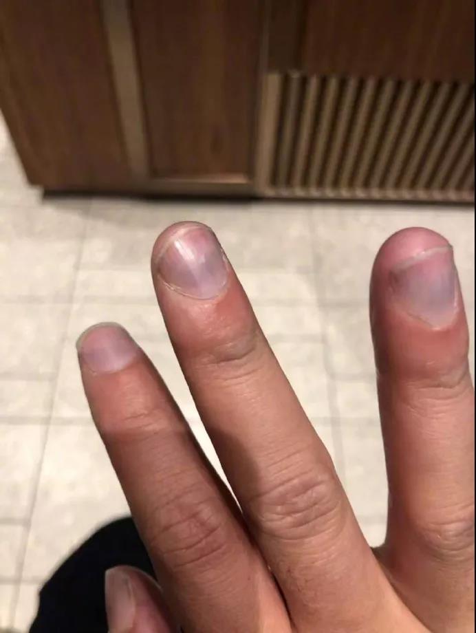 一位网友十个手指突然乌青,于是去医院检查了一圈