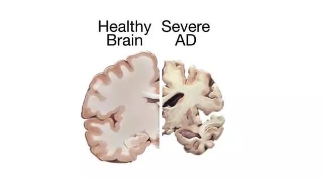 阿尔茨海默病(alzheimer's disease,ad)是最常见的神经退行性疾病,也