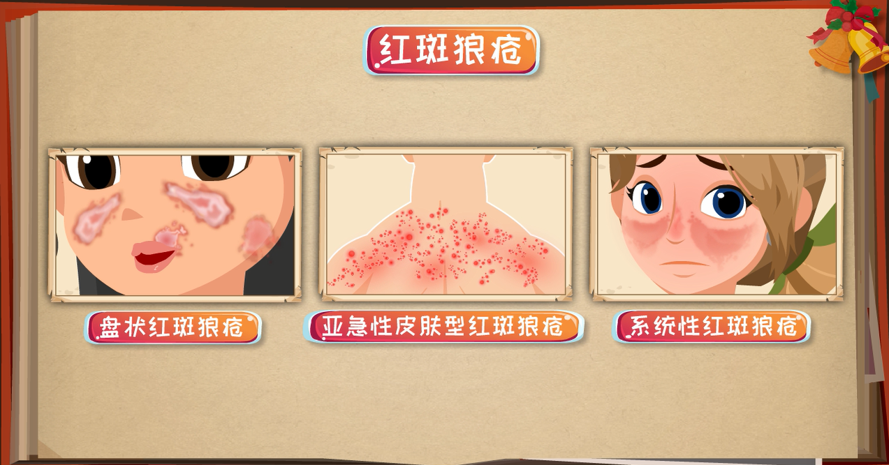 旗下有盘状红斑狼疮,亚急性皮肤型红斑狼疮,系统性红斑狼疮等多种分型