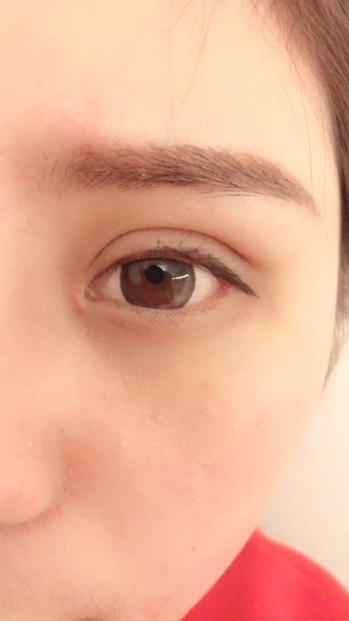 双眼皮失败,宽深假,还是没资质的工作室做的