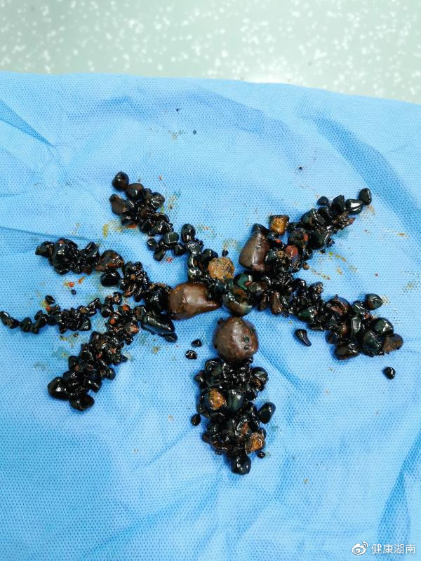 肝胆藏130多颗结石,湖南51岁女子腹痛40余年(图)