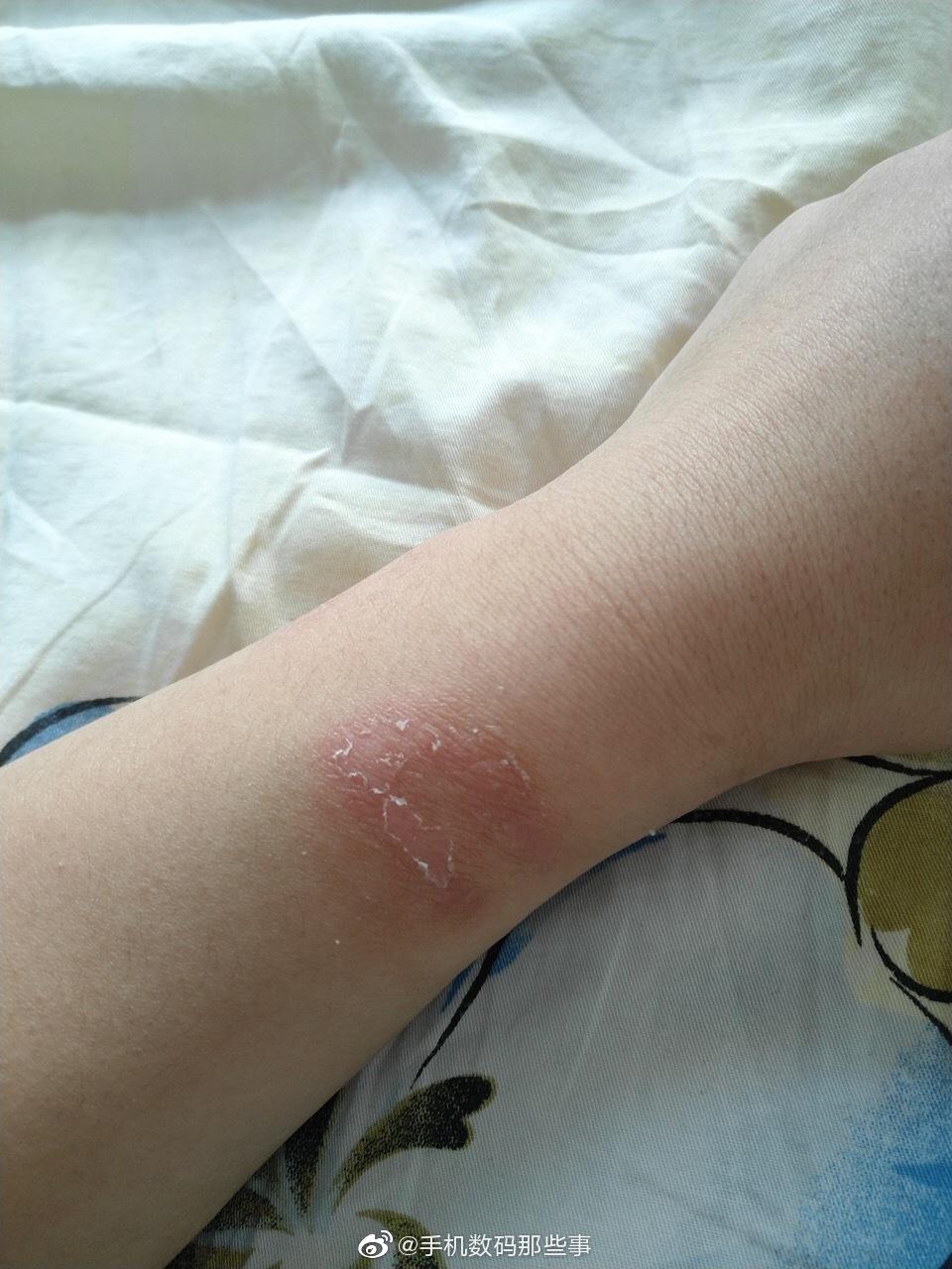 网友投稿佩戴华为watchgt手表一个月以后手腕过敏