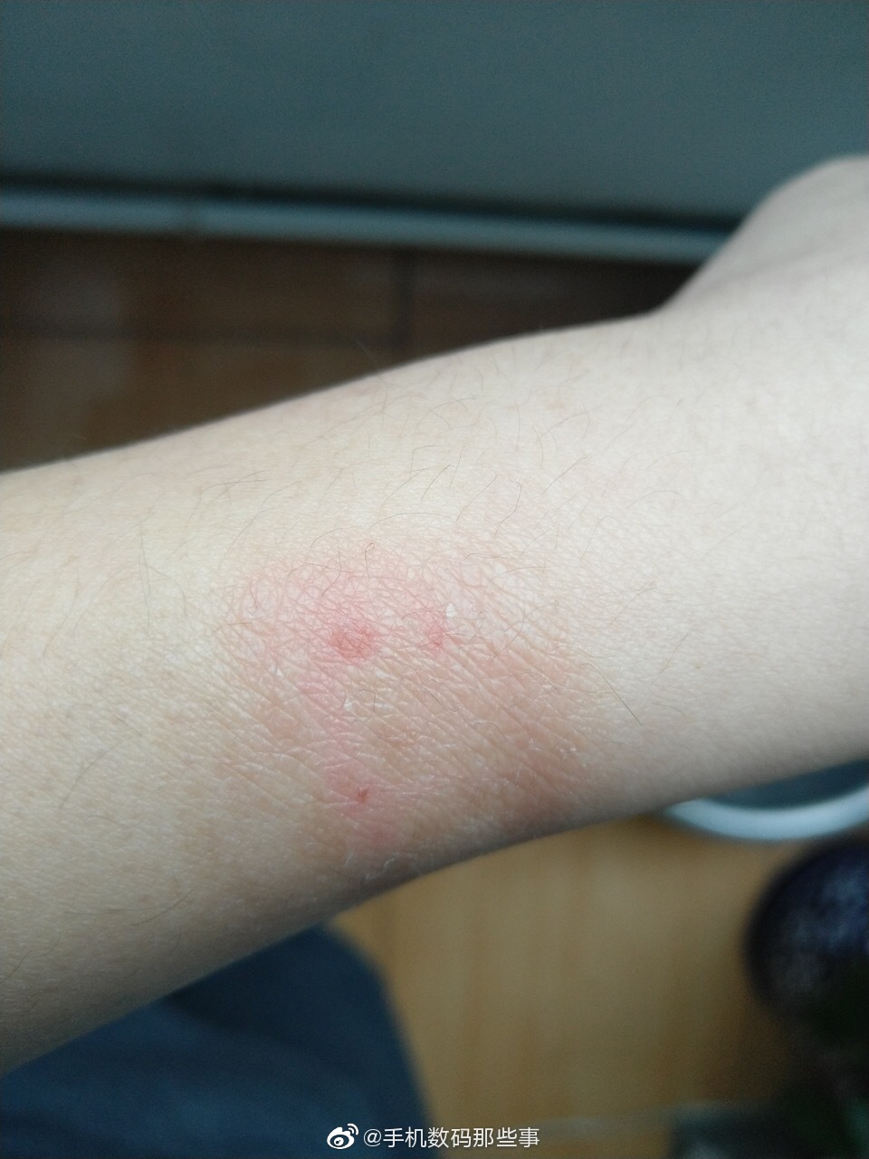 网友投稿佩戴华为watchgt手表一个月以后手腕过敏