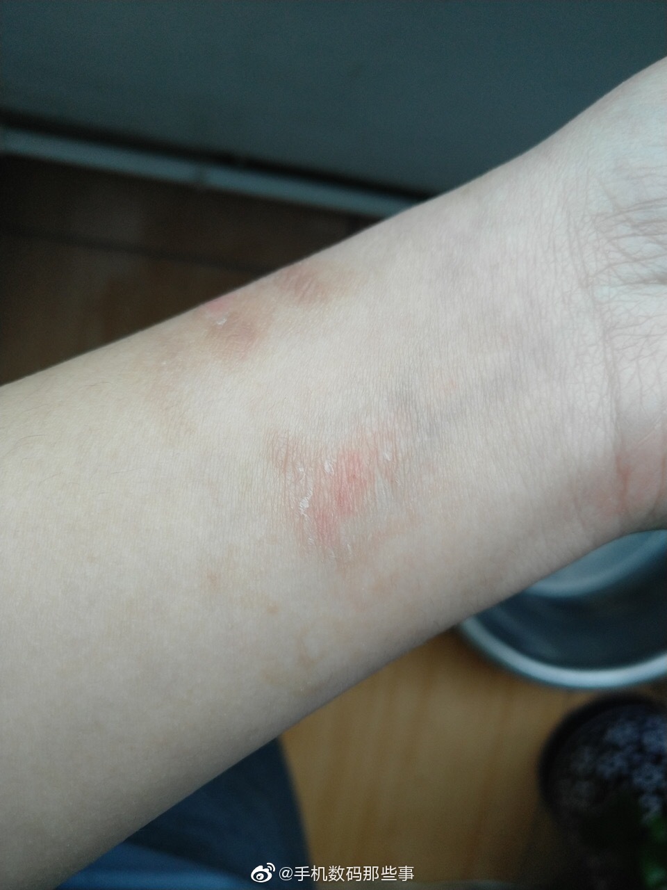 网友投稿佩戴华为watchgt手表一个月以后手腕过敏