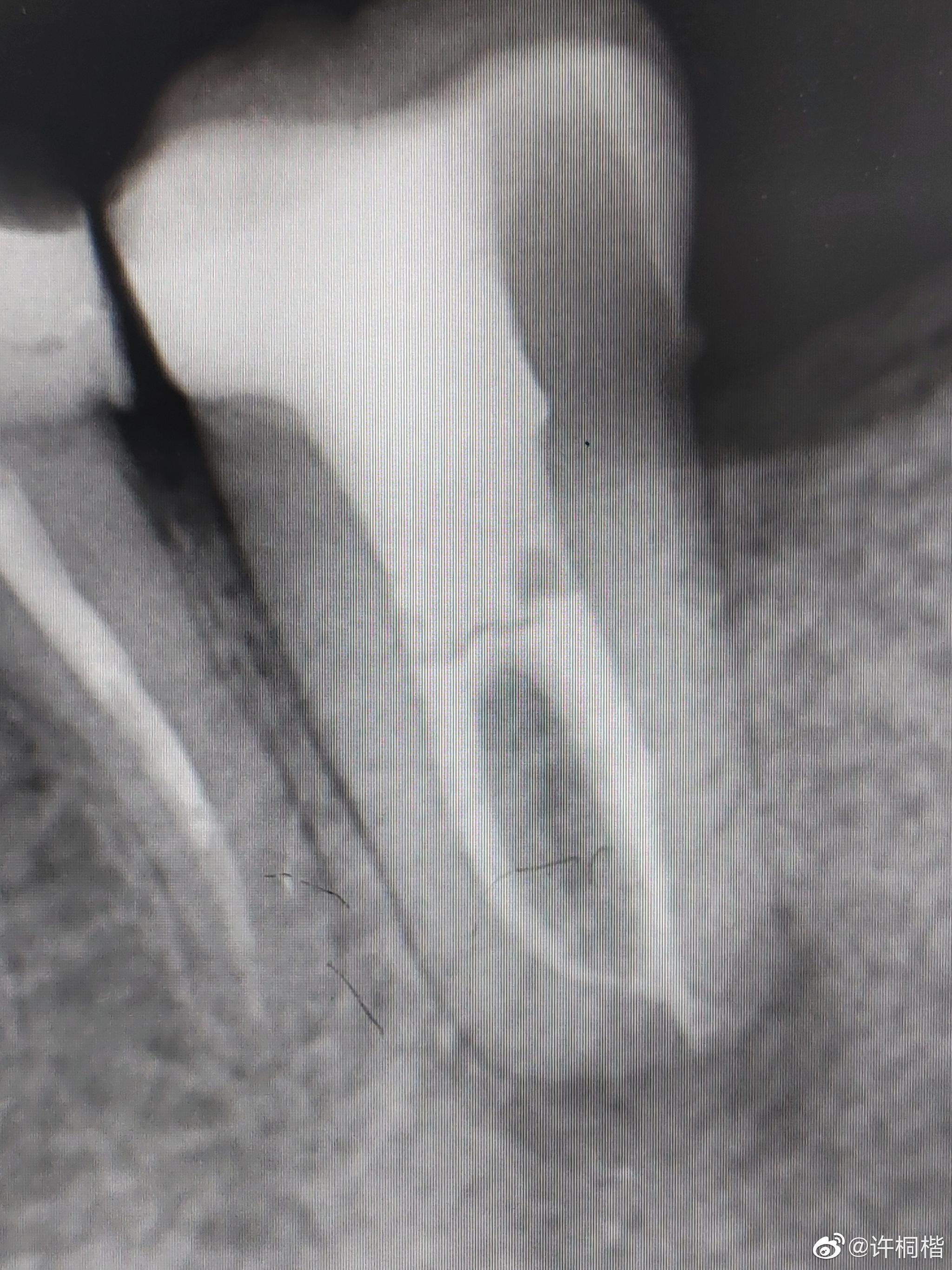 下牙咬东西不舒服图一示牙根周围有病变去年五月份做的根管治疗