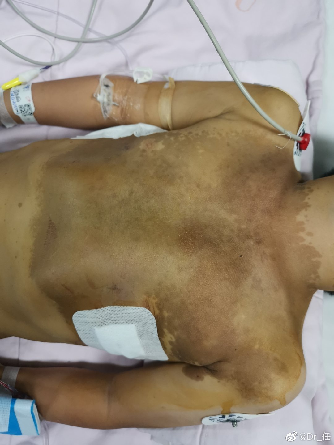 5岁,14公斤,漏斗胸,脊柱侧弯,神经纤维瘤病,行漏斗胸矫治术