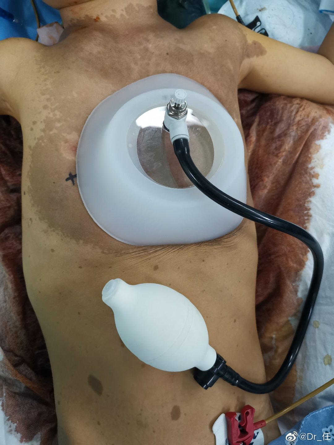 5岁,14公斤,漏斗胸,脊柱侧弯,神经纤维瘤病,行漏斗胸矫治术__财经头条