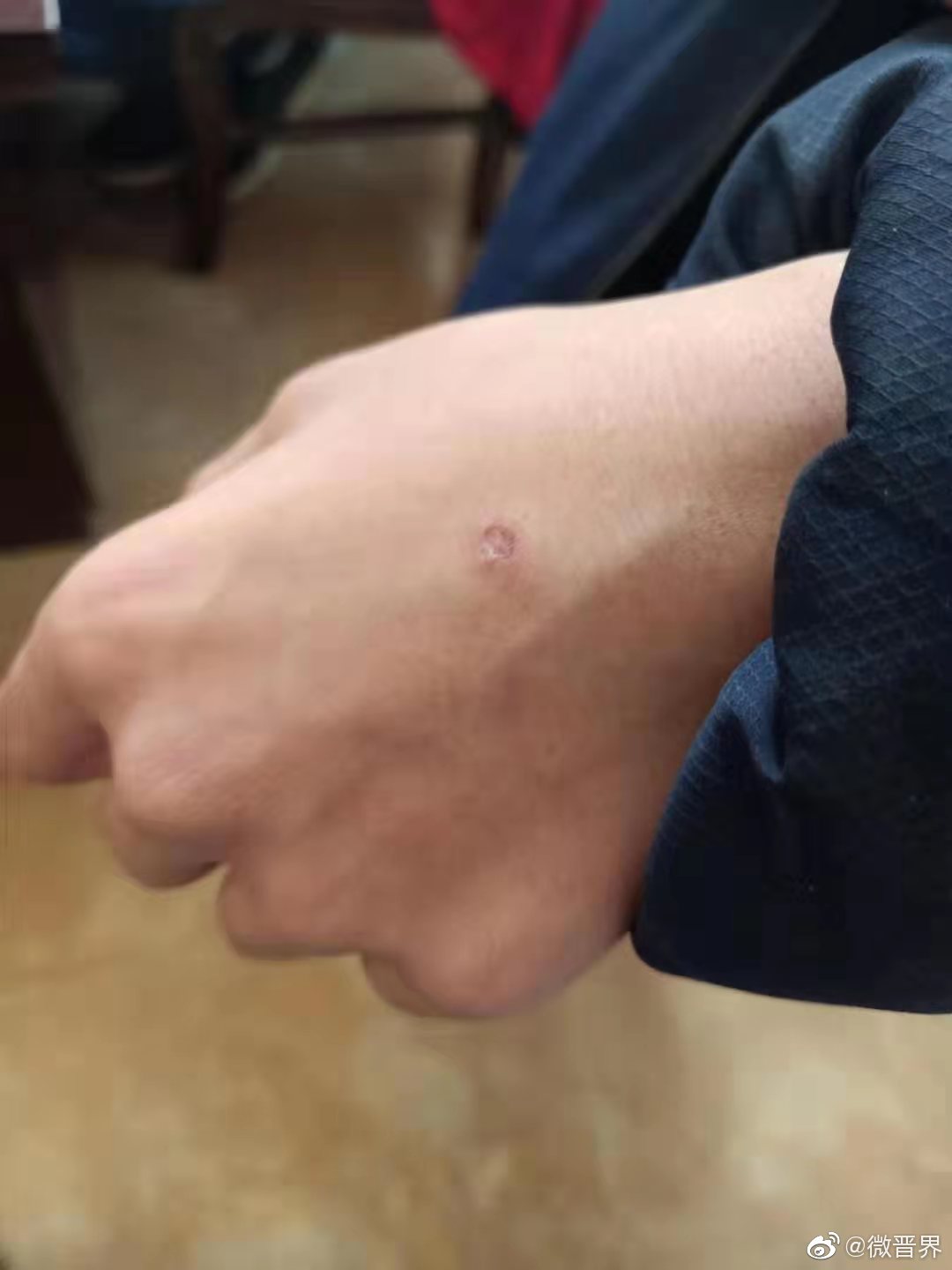 太原一学校4名学生围殴1名同学 持续毒打 手背被烟头烫开坑_高清图集