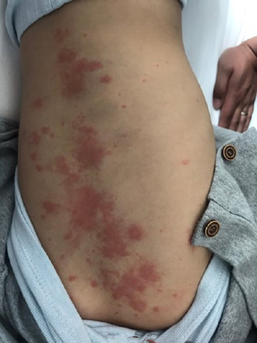 打疫苗真的会引发川崎病吗关于川崎病的事儿一次讲清楚