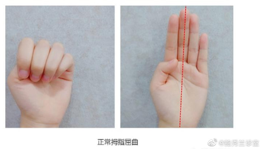 如何鉴别宝宝正常握拳和拇指内扣