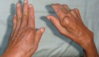 类风湿性关节炎是什么?应该怎样预防?