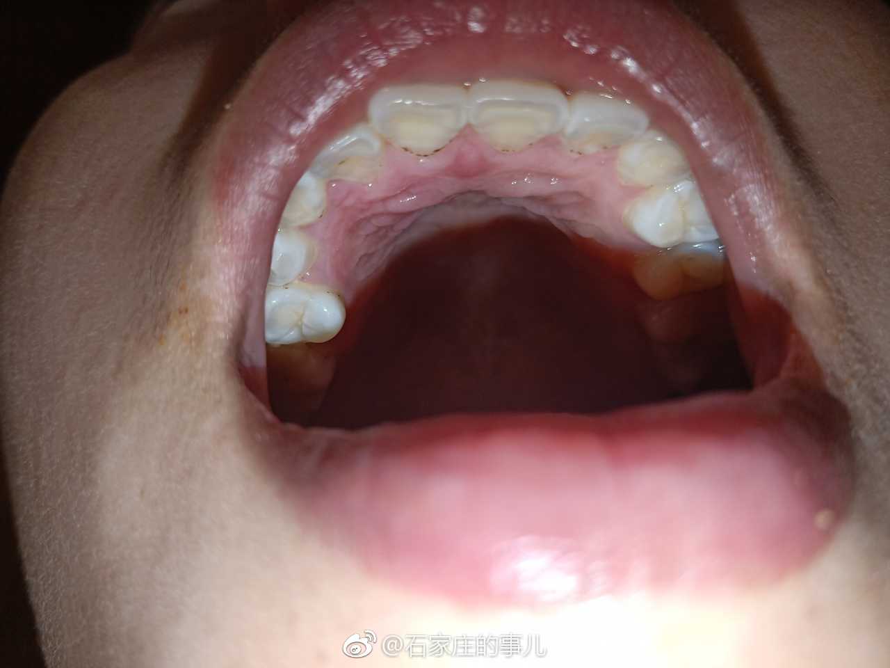 石家庄一网友在香煲吃饭时虾没清理干净虾枪直接插进上颚