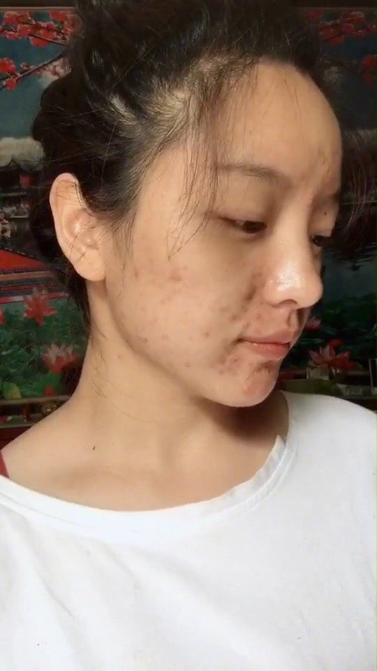 五官颜值很好的女生,千万别被痘痘给毁了