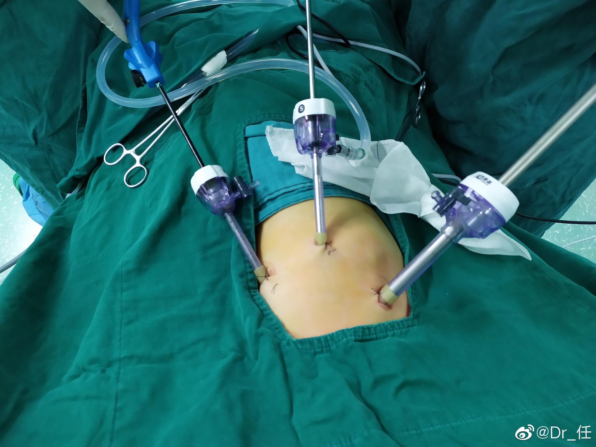 猴哥叶内型隔离肺行胸腔镜左肺下叶基底段切除术