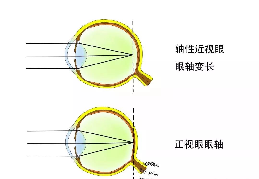 近视眼较正视眼的眼球前后径(即眼轴)长,而高度近视眼具有眼轴不断