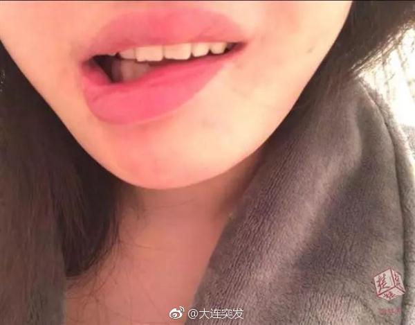 24岁女孩花35万整容看见嘴巴要哭了8个月后更崩溃