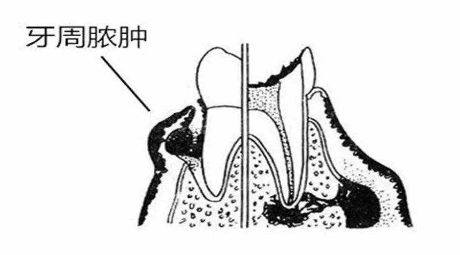 假期中如果生活不規律,抵抗力下降,急性牙周膿腫就會出來作祟