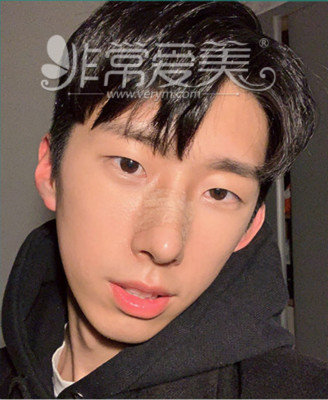 韩国模特整形亲身经历告诉你,男生隆鼻后会帅多少!!