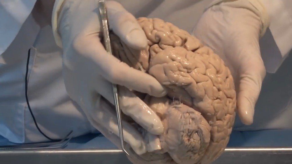 真人大脑的生理结构(神经解剖学视频实验室-脑解剖)以前大脑生理构