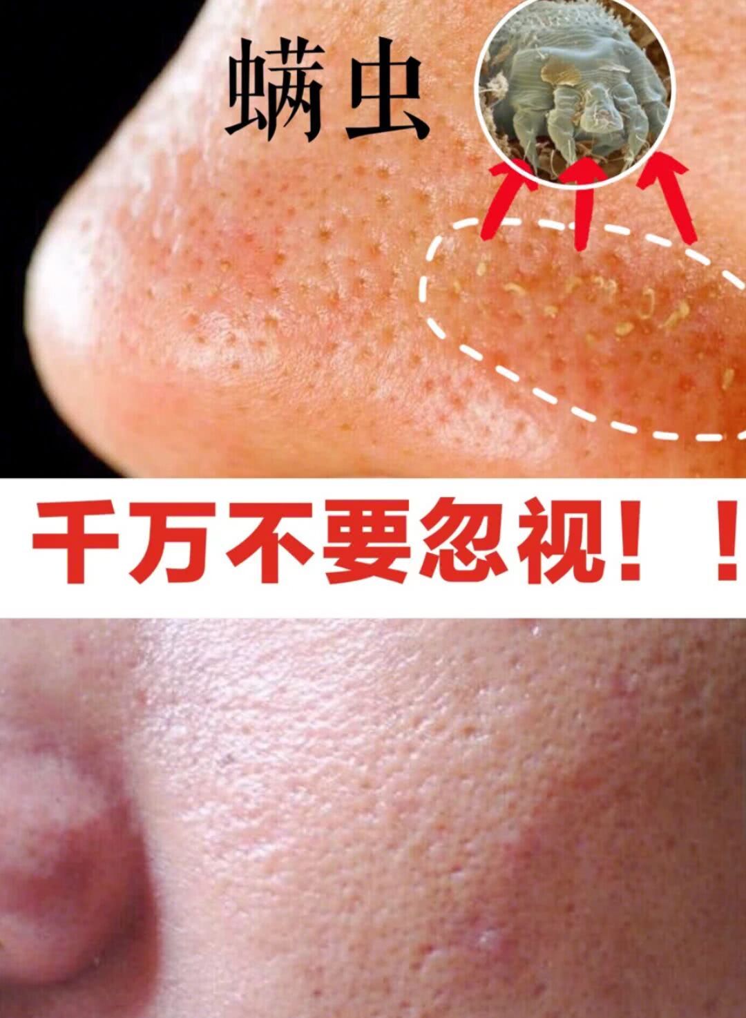 仅用2种天然物,就能把脸上的螨虫"连根拔起",连尸体都找不到