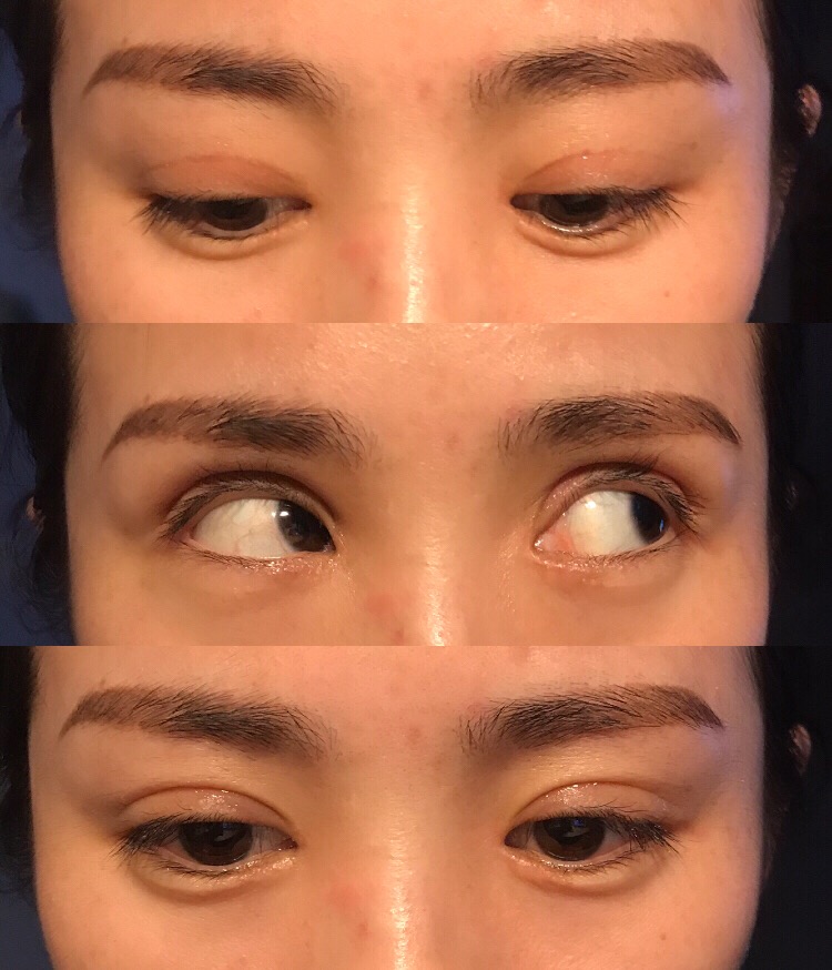 妹子之前是内双,眼角有内眦赘皮|内眦赘皮|双眼皮|眼角_新浪新闻