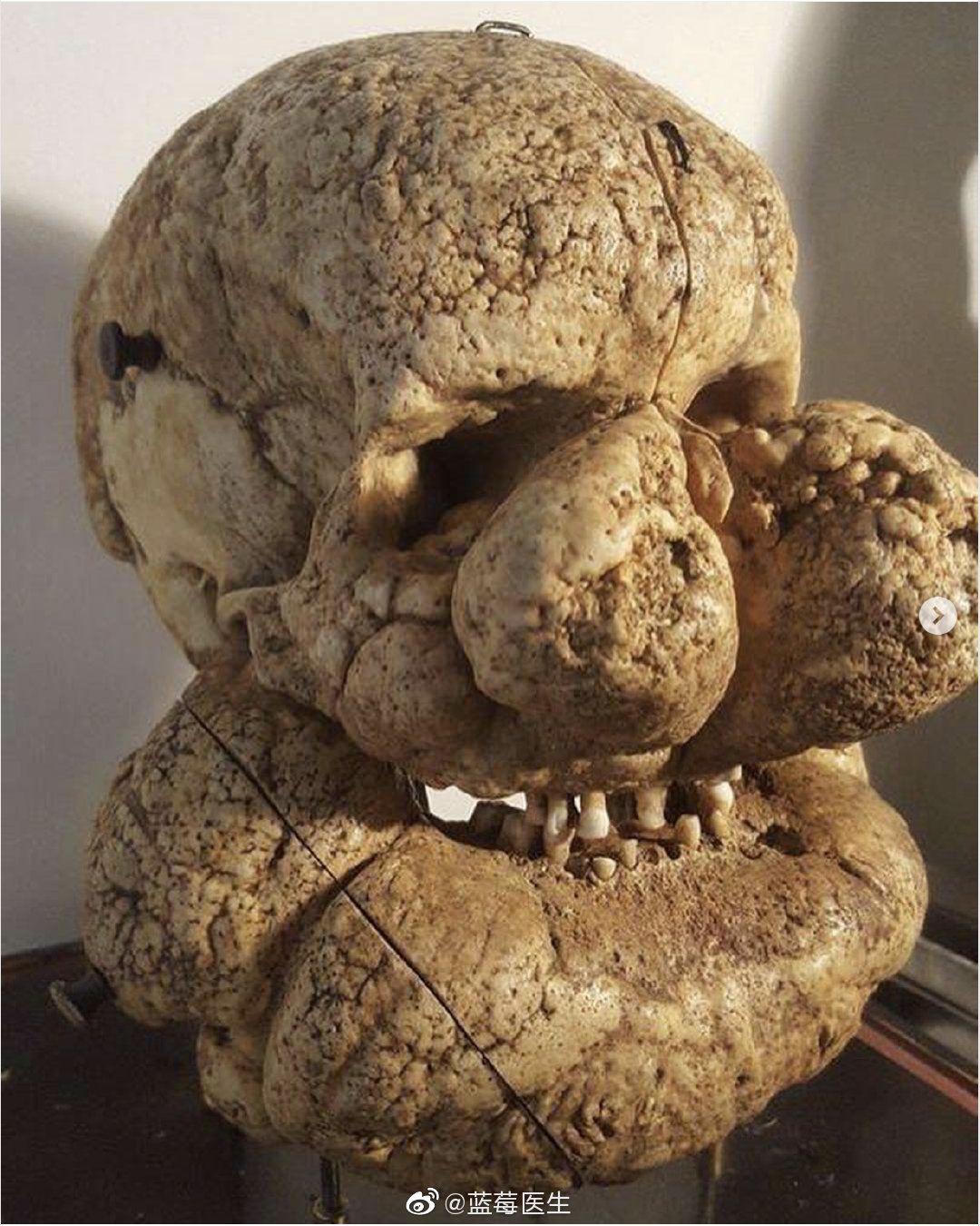 罕见病:"普罗特斯综合征"又名"变形综合征",这是一种非常罕见的症状.