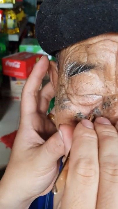 100岁老大爷脸上的黑头,先更一个看看效果
