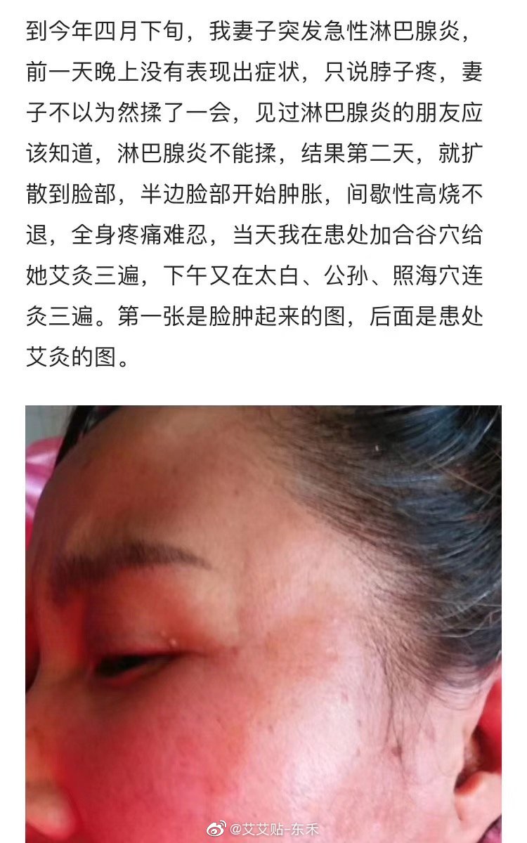 淋巴腺炎不能揉,结果第二天,就扩散到脸部,半边脸部开始肿胀,间歇性