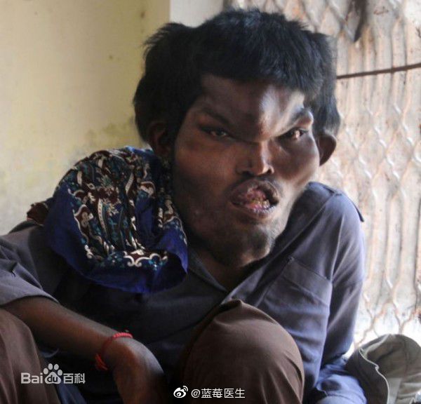 罕见病|罕见病|普罗特斯|综合征_新浪新闻