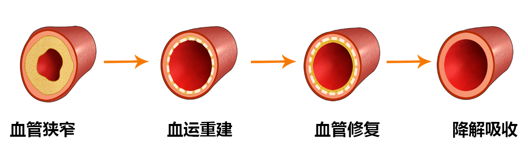 突破!首例NeoVas生物可吸收心脏支架植入者五年随访实录