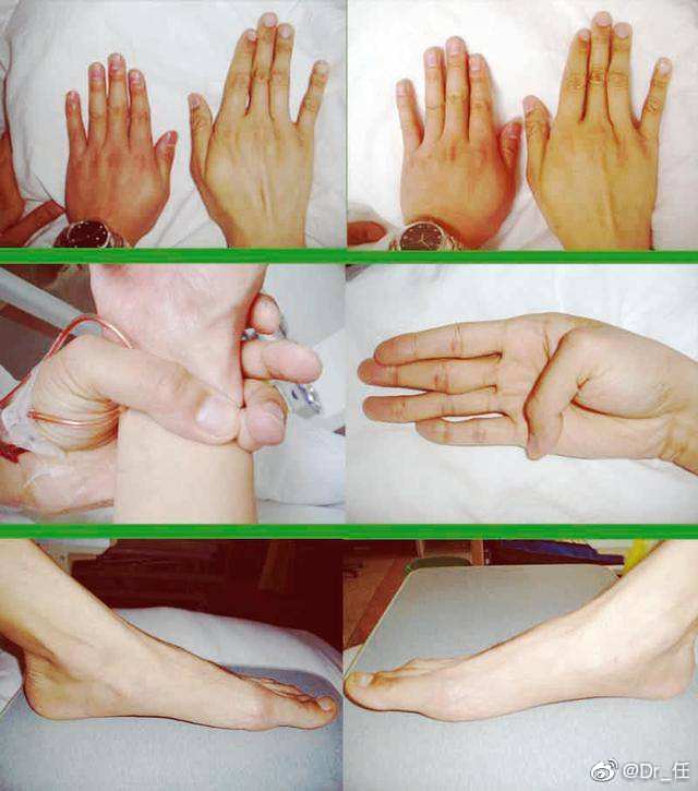 马方综合征又称为马凡综合征,为一种遗传性结缔组织疾病