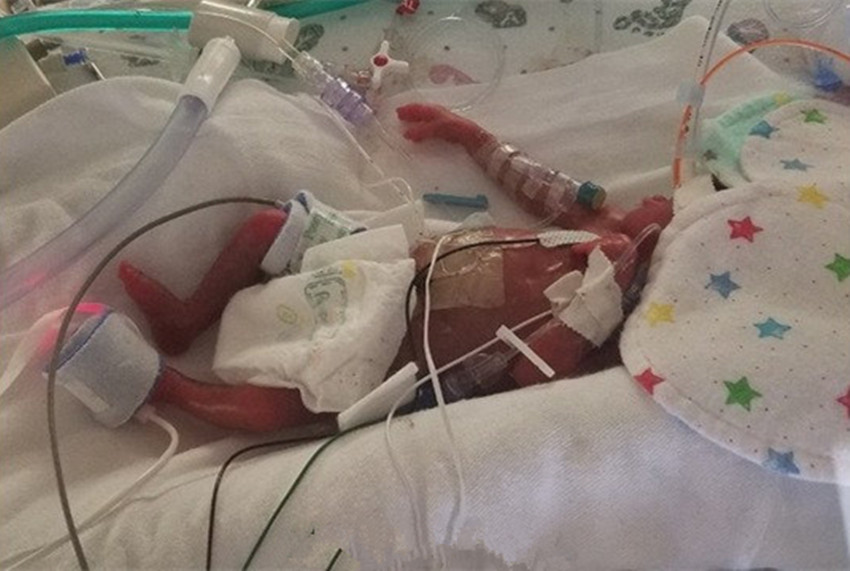 女子怀孕23周早产,出生体型跟爸爸手掌差不多大,全家人都没放弃