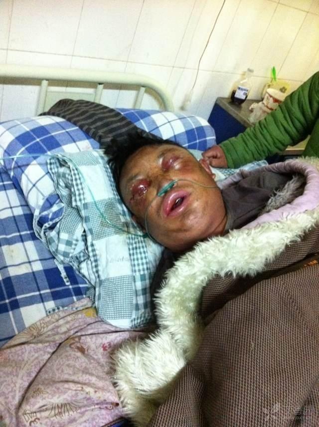 呼吸道炭疽细菌武器早期症状与新冠病毒一样但致死率95以上