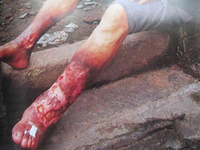 呼吸道炭疽细菌武器早期症状与新冠病毒一样,但致死率95%以上