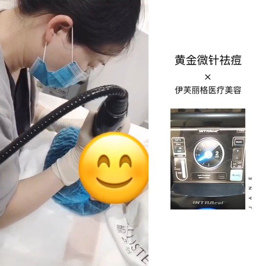 黄金微针射频祛痘坑真的可以算诊所的明星项目了