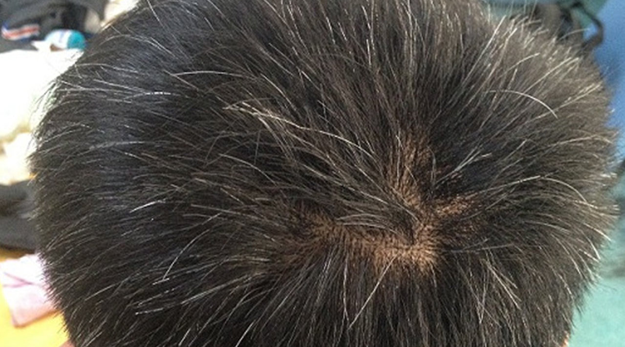 白头发会越拔越多吗?情况可能和你想的不一样!别瞎猜了