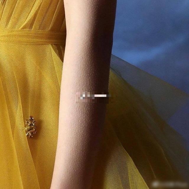 输液起鸡皮疙瘩(输液起鸡皮疙瘩怎么处理) 输液起鸡皮疙瘩(输液起鸡皮疙瘩怎么处理)