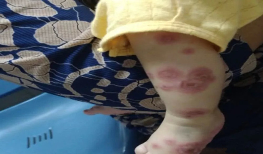 所谓被动转移型,就是患自身免疫性疾病的妈妈,主要为系统性红斑狼疮和