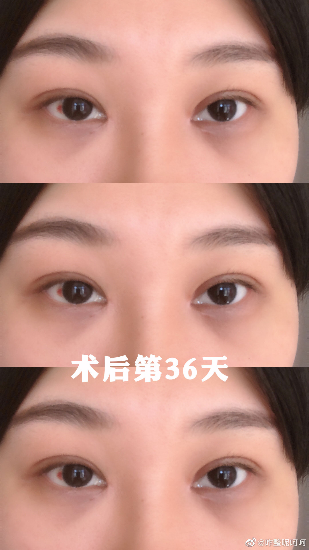 全网首档短视频 -肿眼泡全切双眼皮|双眼皮|下睑|手术_新浪新闻