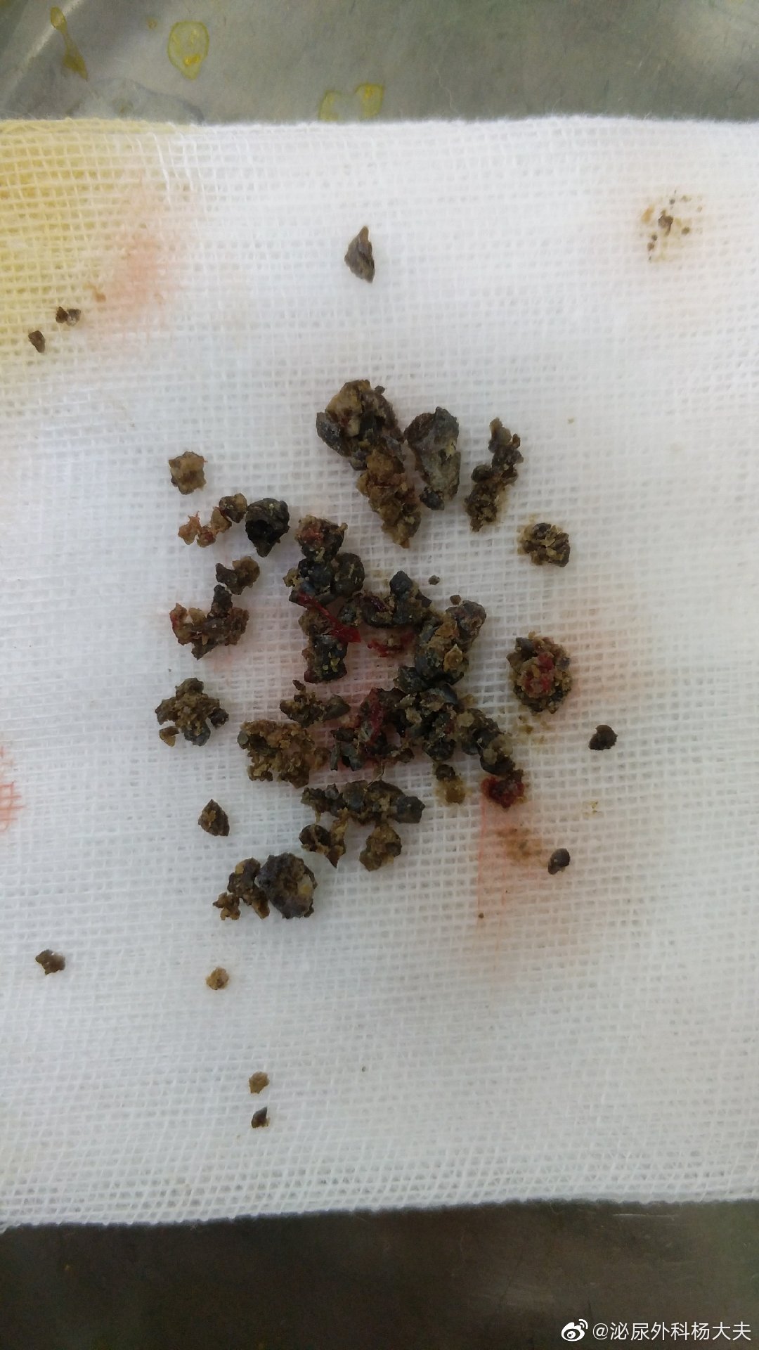 这是一例小肾盂,下盏结石,腰上一个孔已无法处理所有结石