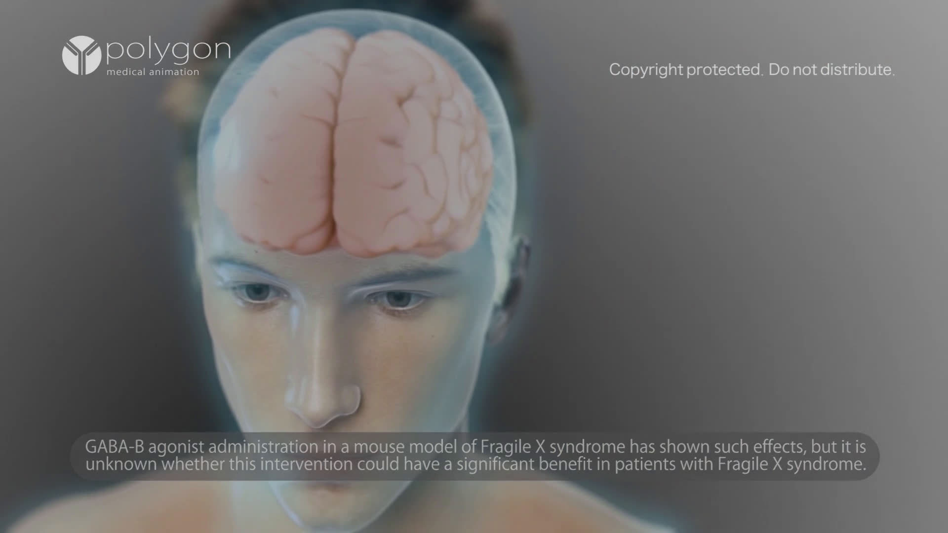 脆性x染色体综合征是一种x连锁不完全外显性遗传病