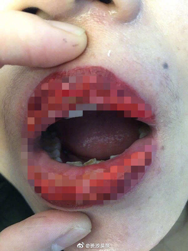 29岁女子满心期待樱桃唇漂唇术后长满水疱流脓水