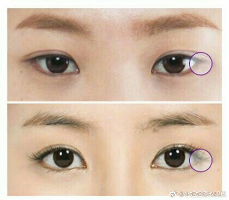 眼睑下至每个人都能做吗下眼睑下至术能够让眼睛看起来更大