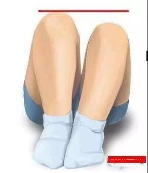 2,allis征,如下图,小儿平躺,使其双膝屈曲,脚面着床,正常者应双膝处于