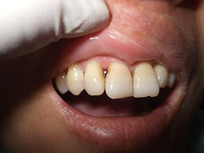 3招教你:如何避开牙齿”黑三角“?