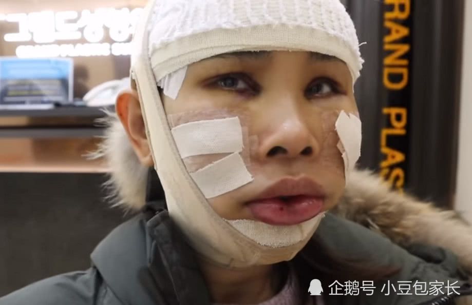 33岁女子整容全过程,网友:虽然过程痛苦,但真的好漂亮,值了|整容|手术