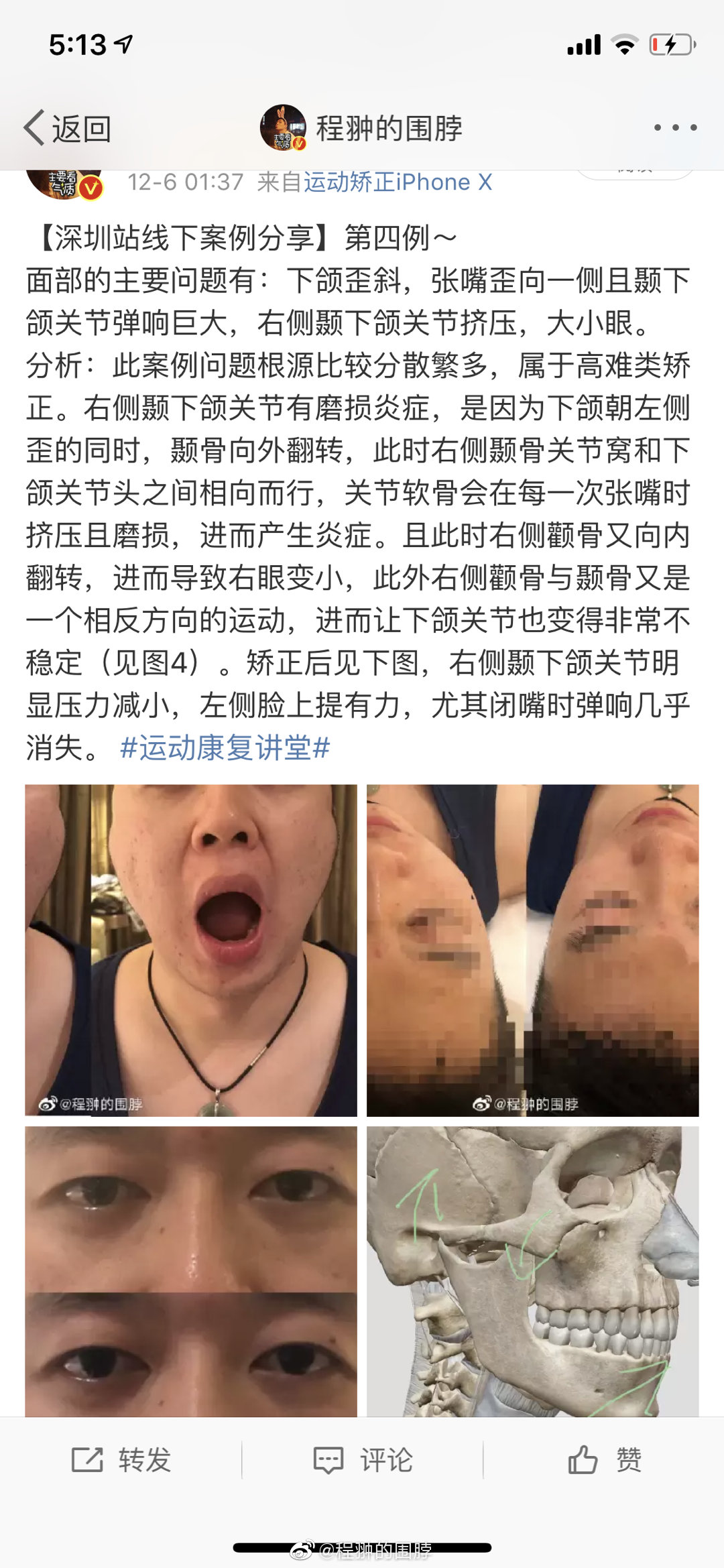 收到深圳站的一例严重颞下颌关节紊乱的案例反馈